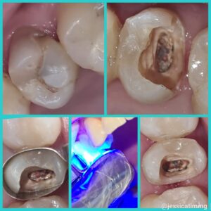 Tratamento de caries e canal